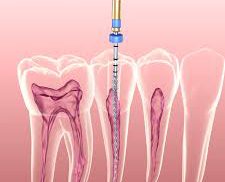Root-Canal-Treatment-225x182