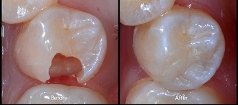 cavity-procedure-before-after