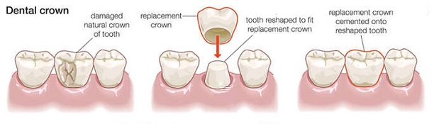 Dental Crown Diagram