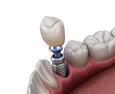 Image showing a Dental Crown on an implant