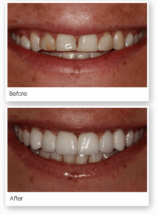 Before & After image showing discolored Teeth Fixed with Dental Veneers