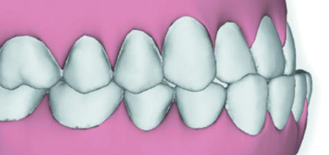 image of teeth underbite