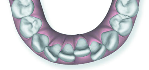image of teeth crowding condition which can be treated by Invisalign