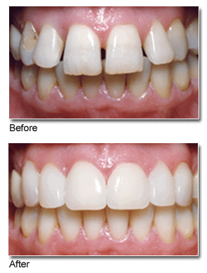 Before & After image showing Gapped Teeth Fixed with Dental Veneers
