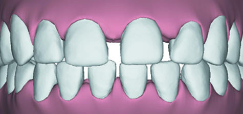 image of teeth spacing condition which can be treated by Invisalign