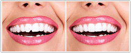 tooth-bonding-before-after