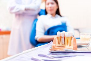 A Comprehensive Overview of Dental Implants: Complications and Risks