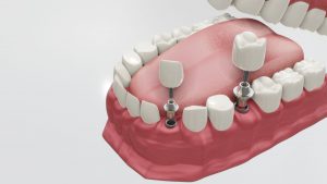 Dental Implants: The Top Choice for Replacing Teeth