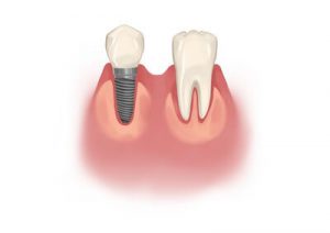 Understanding Dental Implants for Patients with Periodontal Disease