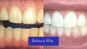 How to Find the Best Teeth Whitening Clinic in Buford, Georgia