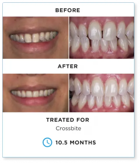 Patient treated with the SureSmile Clear Braces