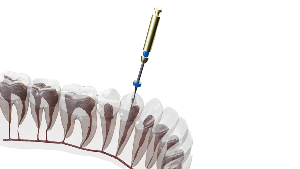 Root canal treatment Illustration